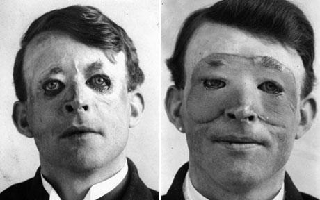 Facial Plastic Surgery – A Historical Perspective